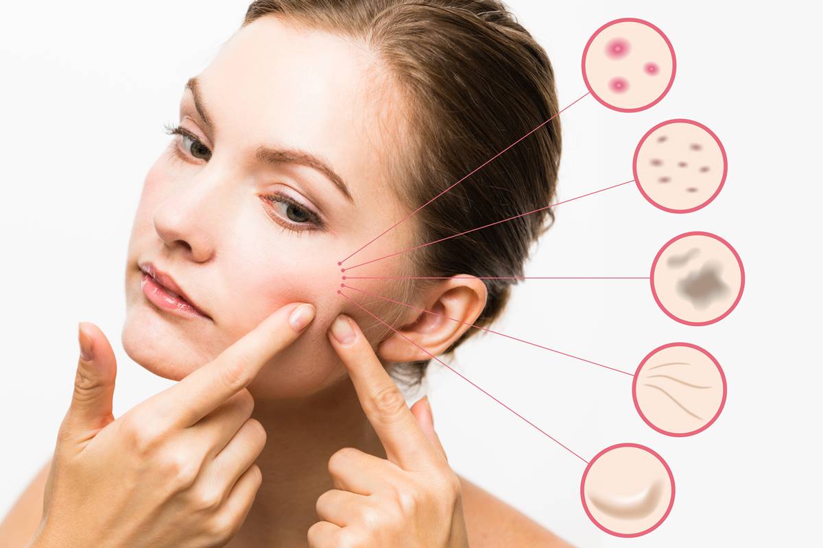 Expert Tips On Erasing Acne Scars Forever