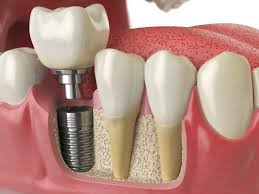 Understanding Dental Implants Cost in the UK: Factors, Considerations, and Options