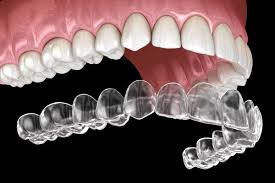 Best Invisalign Dentist in Turkey: A Comprehensive Guide